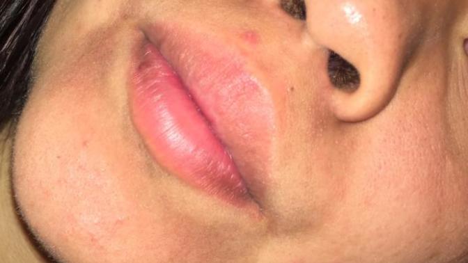 How do I get rid of this red dry skin?