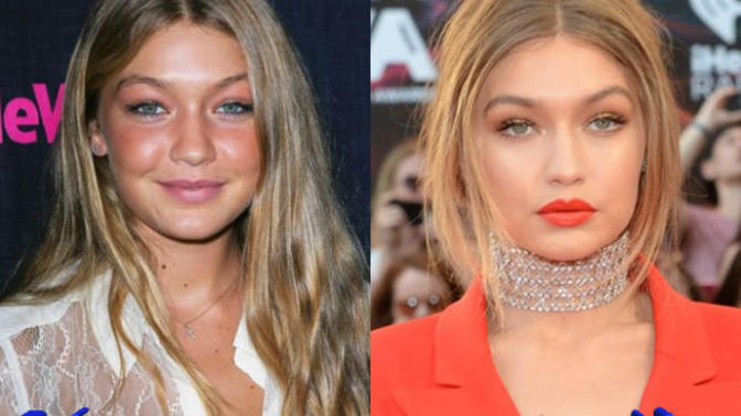 Did gigi hadid get Plastic surgery?