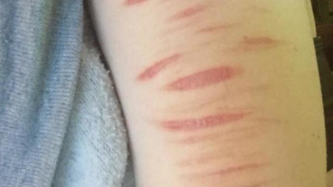 Will these scars keep me from getting employed? (Trigger warning)?