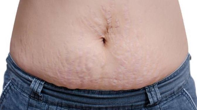 Would you still be as Attracted to someone if they has Stretch Marks? What if they were from having Kids Together?