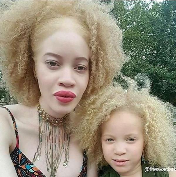 If a black person is born albino does that still make them black or does that make them white?