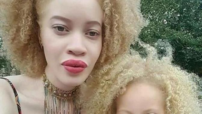 If a black person is born albino does that still make them black or does that make them white?