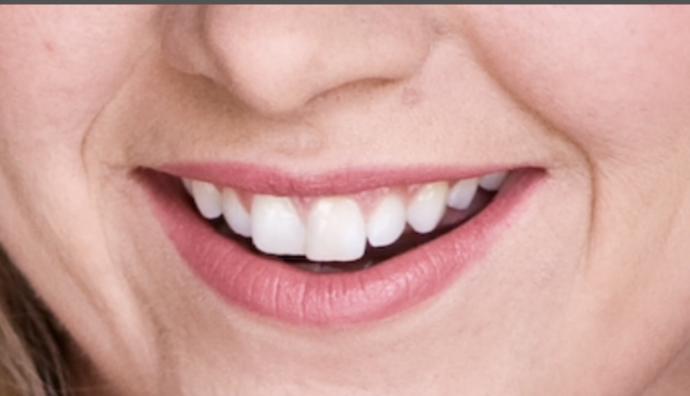 Do u think I should get braces?