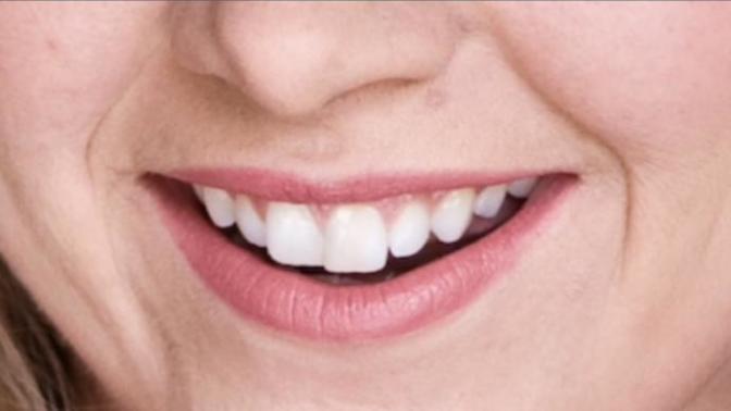 Do u think I should get braces?