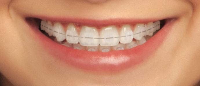 What braces look better? 
