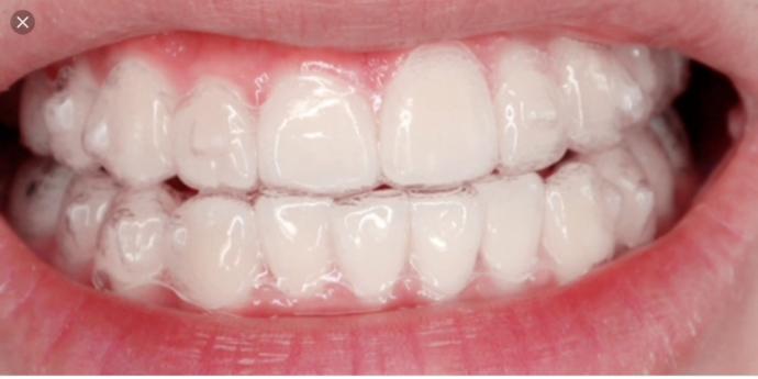 What braces look better? 