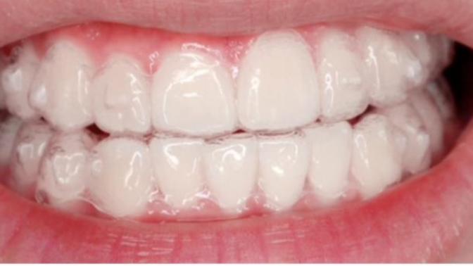 What braces look better?