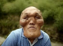 Would you be friends with someone who has a severe facial deformity?