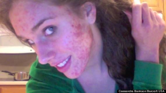 Have you ever found at least one guy/girl with acne, that was surprisingly attractive?