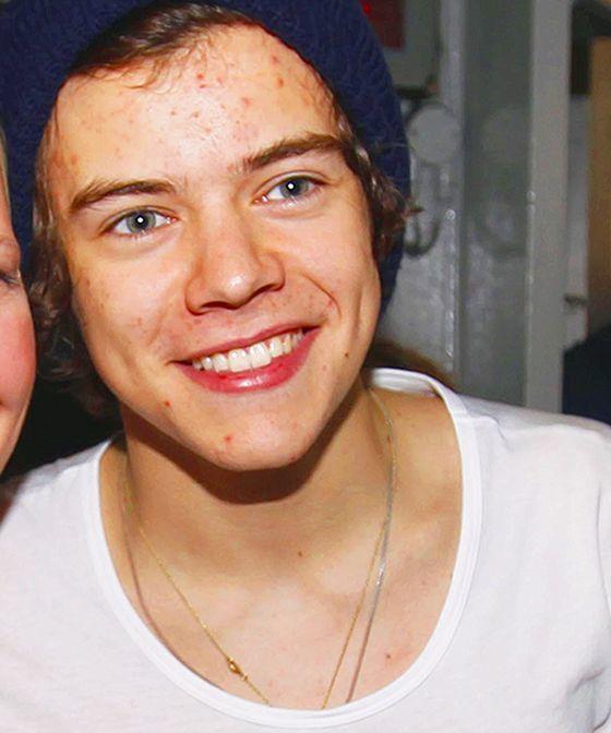 Have you ever found at least one guy/girl with acne, that was surprisingly attractive?