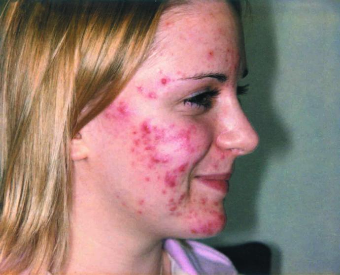 Have you ever found at least one guy/girl with acne, that was surprisingly attractive?
