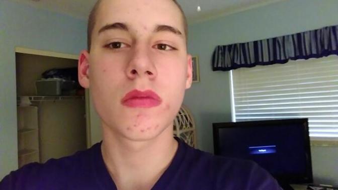 Do girls dislike acne is it a major turn off?