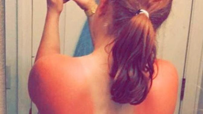 What's a good way to recover from a sunburn?