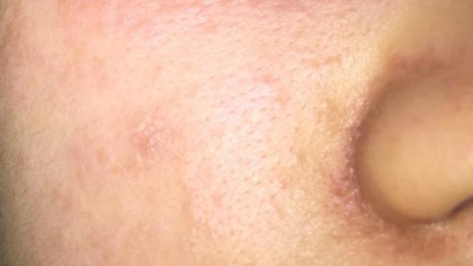 How do I get rid of breakouts from not washing my makeup sponge enough?