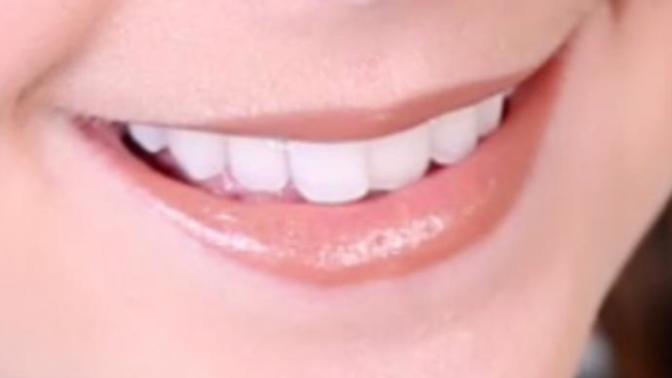 How do you feel about when one front tooth overlaps the other?