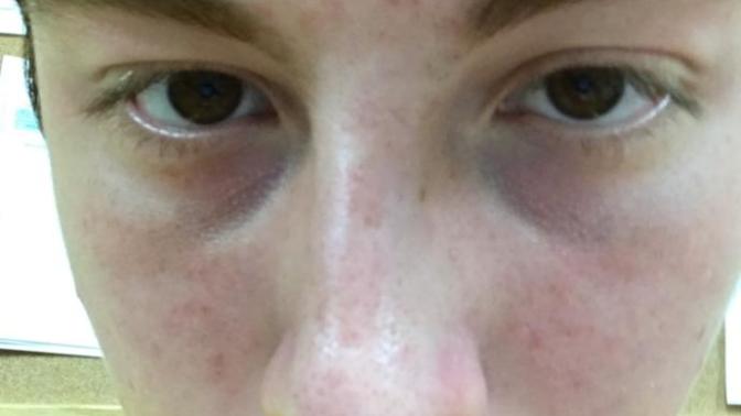 How bad is my acne on a scale of 1-10? Would you still date me?