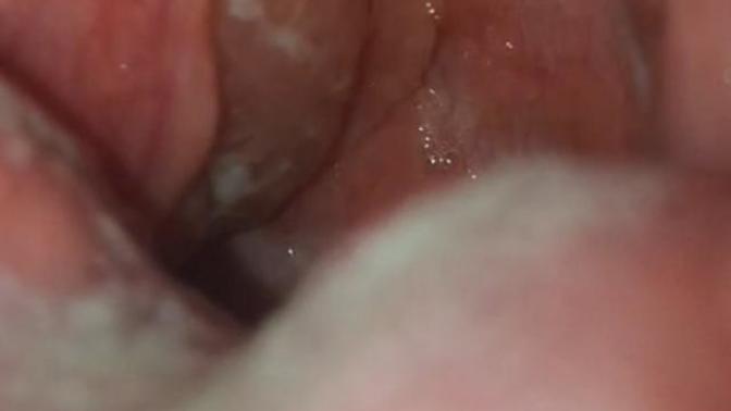 Throat is really really sore. Is it strep or tonsillitis?