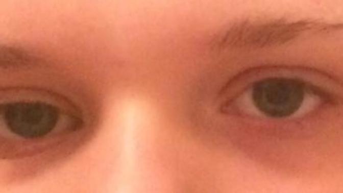 Is my lazy eye a turn off?