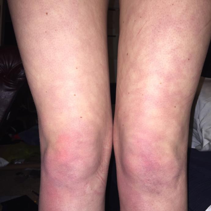 Would you find someone who had year-round Livedo Reticularis attractive still?