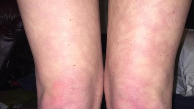 Would you find someone who had year-round Livedo Reticularis attractive still?