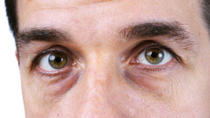 How to get rid of this blue line under the eyes?