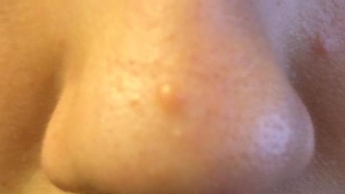 What's on my nose? Strange bump?