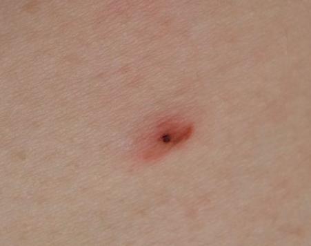 Do I have a tick bite? Worried sick over this?