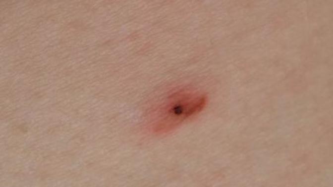 Do I have a tick bite? Worried sick over this?