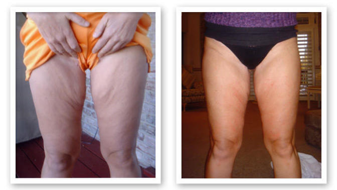 Guys, Guys would you date a girl who's lost weight (100 lbs) and has some loose skin on stomach, inner thighs and boobs are kind of saggy?