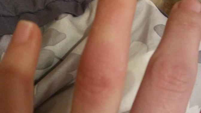 What kind of bite is this?