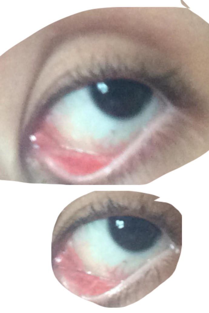 Do i have pink eye girlsaskguys