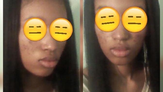 Why do people judge acne scars?