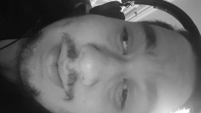 Ladies does my Lazy eye bother you?