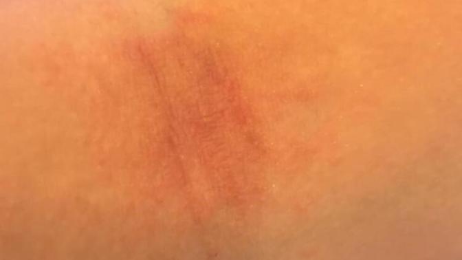 Rash on inside of elbow? What is it?