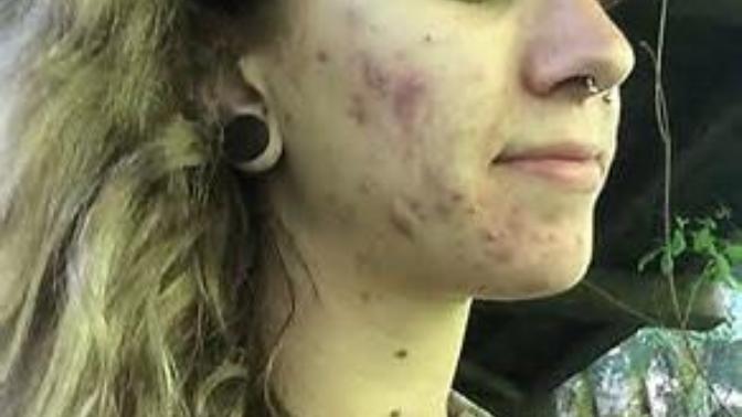 Would you date girls with acne?