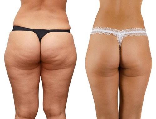 Guys do you care about Cellulite?