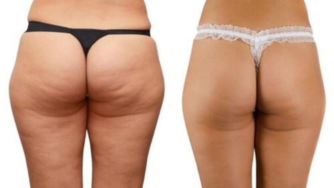 Guys do you care about Cellulite?