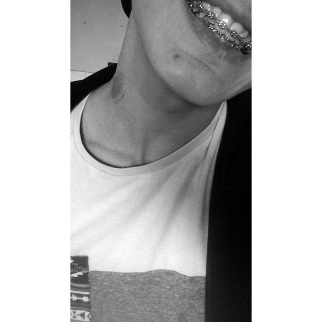 What do you think about braces??