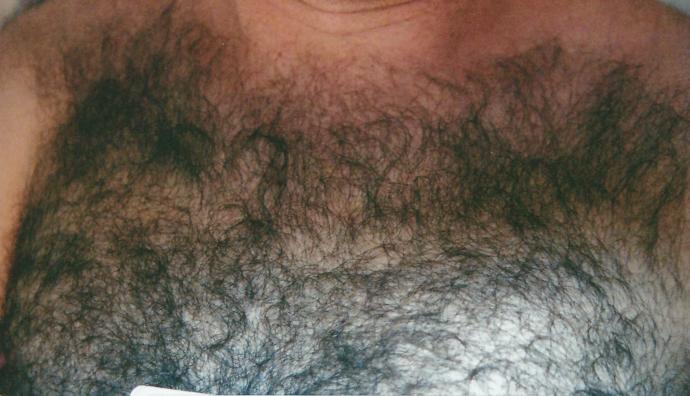 Girls, Would you support and love it if your man for whole body laser hair removal?