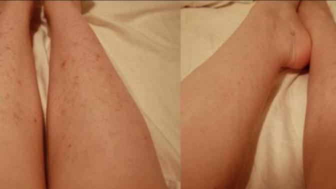 Are spots on legs a turn off?