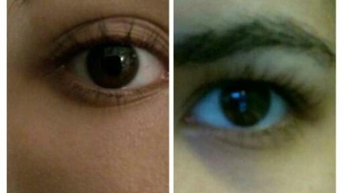Only when I have swollen eyelids I can make my eyes look bigger with eyelid tape , help?
