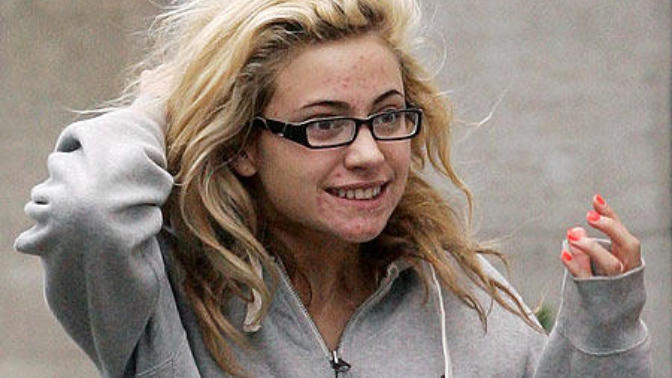Do you notice acne on people?