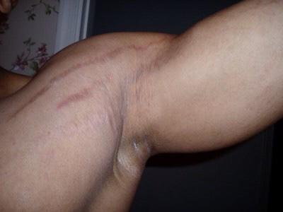 Are stretch marks on the arm unattractive?