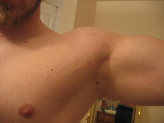 Are stretch marks on the arm unattractive?