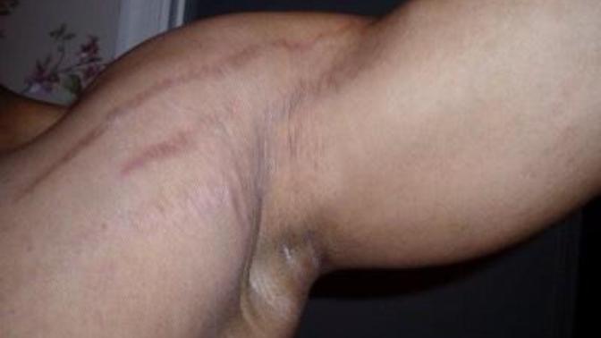 Are stretch marks on the arm unattractive?