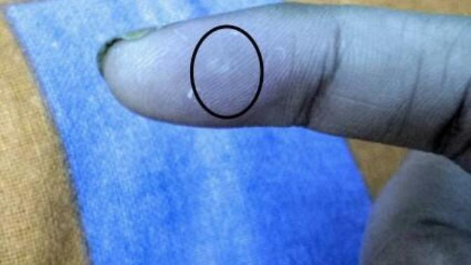 There is strange, white bump on my finger. It's very tiny but itchy and irritating. Wouldn't pop. Any idea what is it?