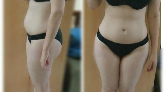 Am I too fat for a bikini?
