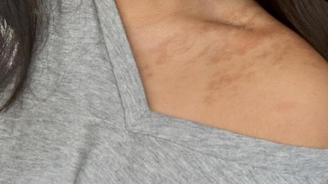 Does anyone else have a big birthmark and would it be a turn of if the girl you were talking to had one like mine?