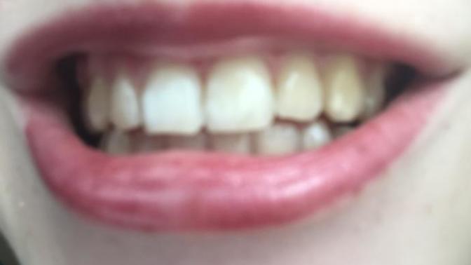 Will anyone ever like me with my teeth?