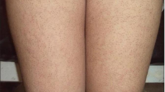 How do you get rid of keratosis pilaris fast?